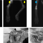 【症例紹介】踵骨骨折（かかとの骨折）