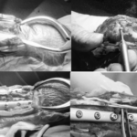 【症例紹介】手根脱臼（関節固定）