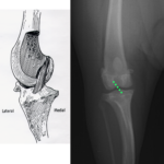 【症例紹介】膝蓋骨脱臼と前十字靭帯断裂（ＴＰＬＯ）